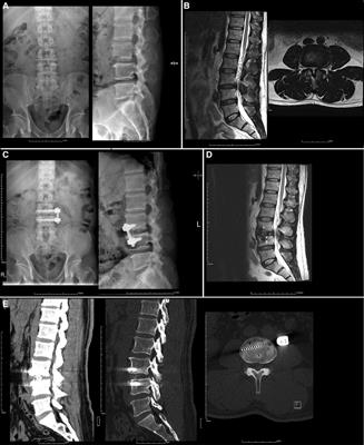 Oblique lateral interbody fusion in heterogenous lumbar diseases: Anterolateral screw fixation vs. posterior percutaneous pedicle screw fixation – A single center experience